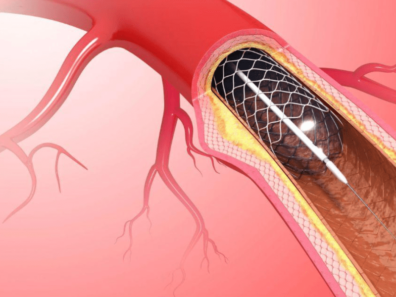 The First FDA-Approved Stent Tailored for Newborns with Congenital Heart&nbsp;Disease